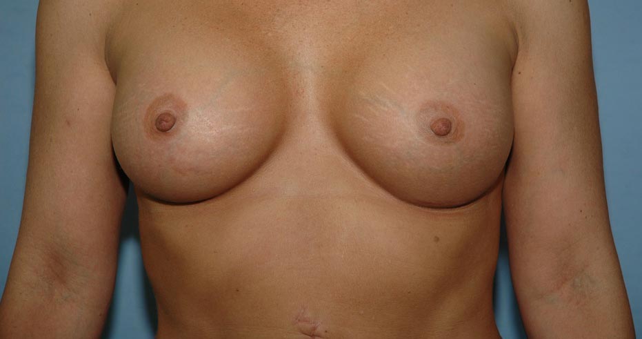 breast11